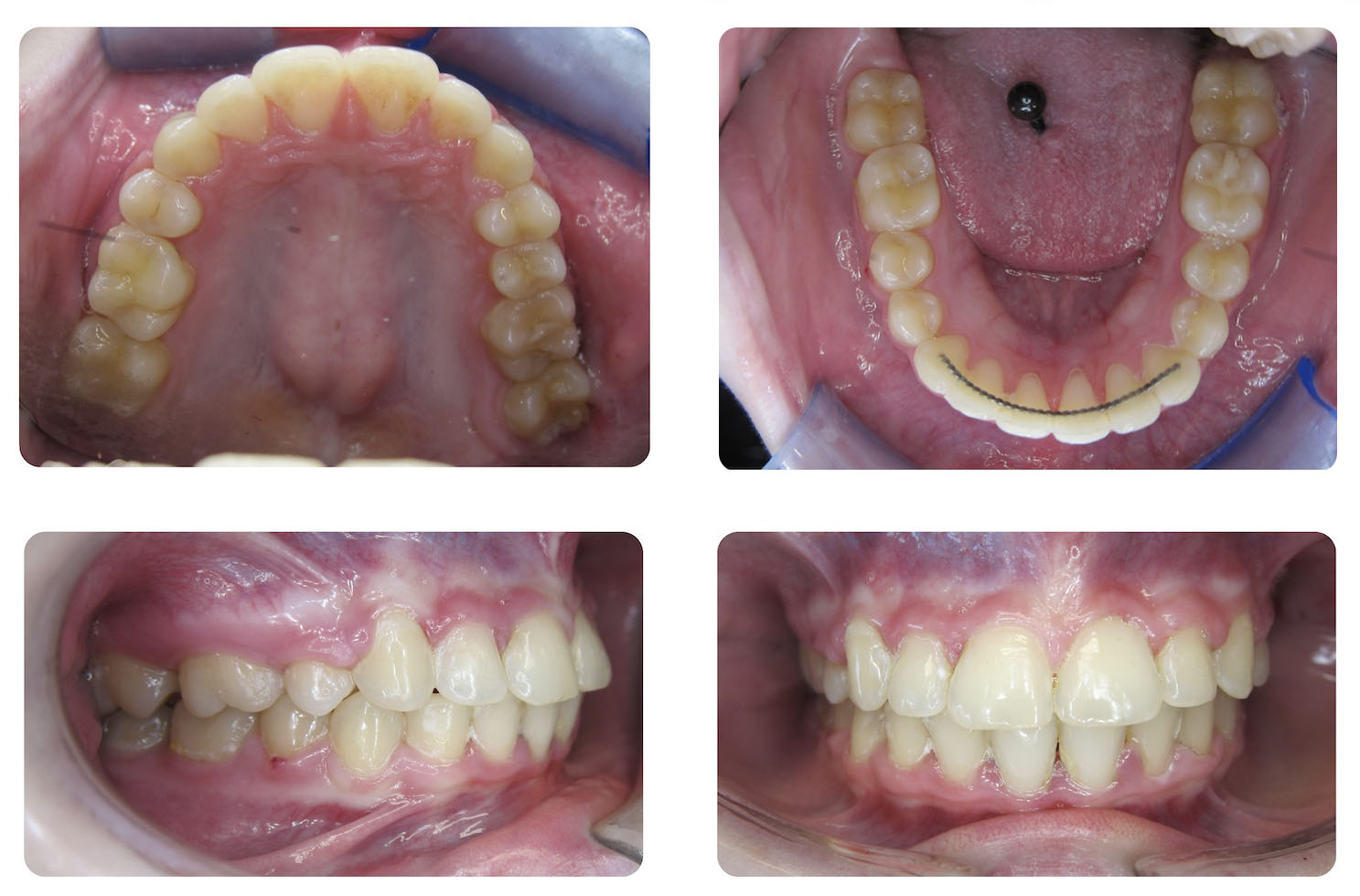 Four close-up intraoral photos show upper and lower dental arches and side and front views of teeth alignment with dental prosthetics present on the lower jaw.