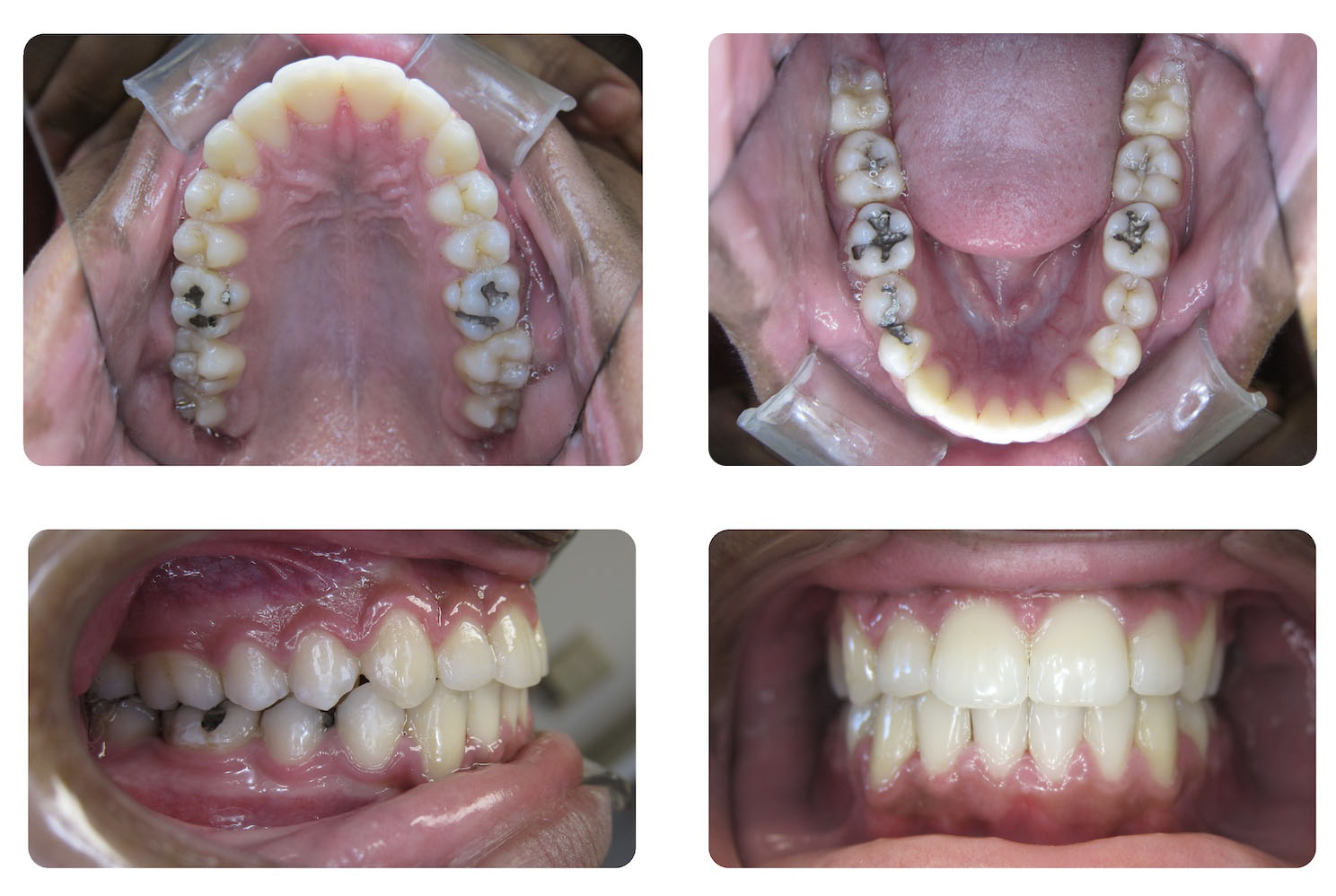 Four dental photos show upper and lower teeth with cavities and fillings in the top row, and improved, restored teeth in the bottom row.