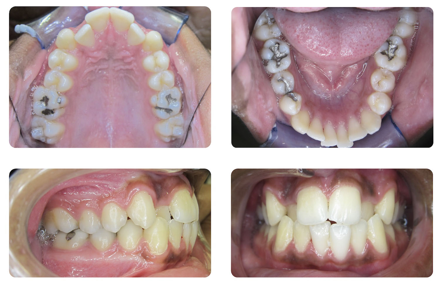 Four dental images show upper and lower teeth arches with visible cavities, and side and front views displaying misaligned teeth and dental crowding.